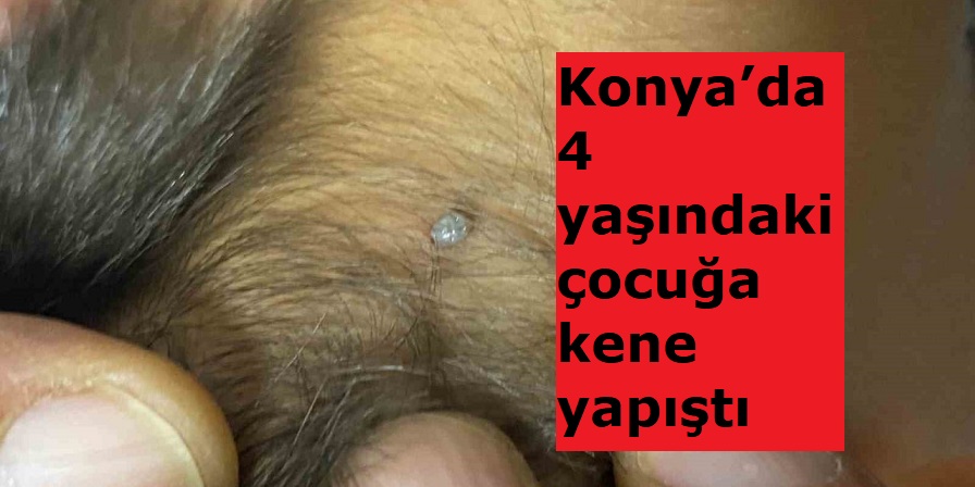 Konya’da 4 Yaşındaki Çocuğa Kene Yapıştı