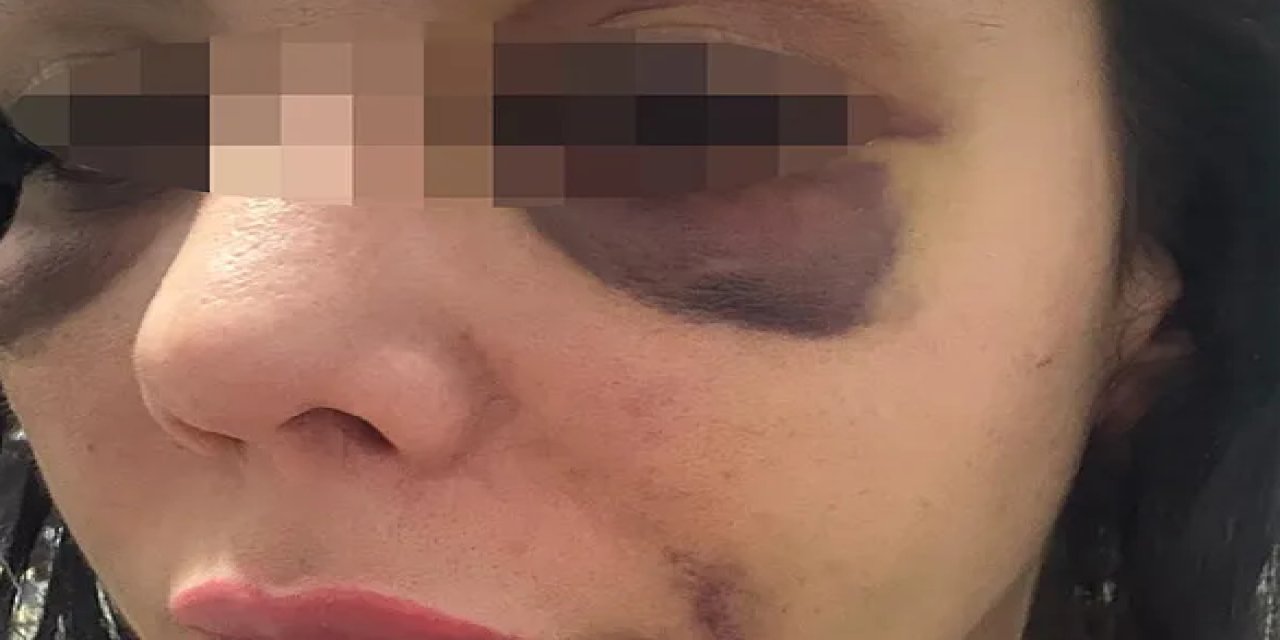 Kıskançlık Kavgasında Karar Çıktı: Saldırgan Kadına Para Cezası