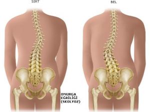 Skolyozda erken teşhis